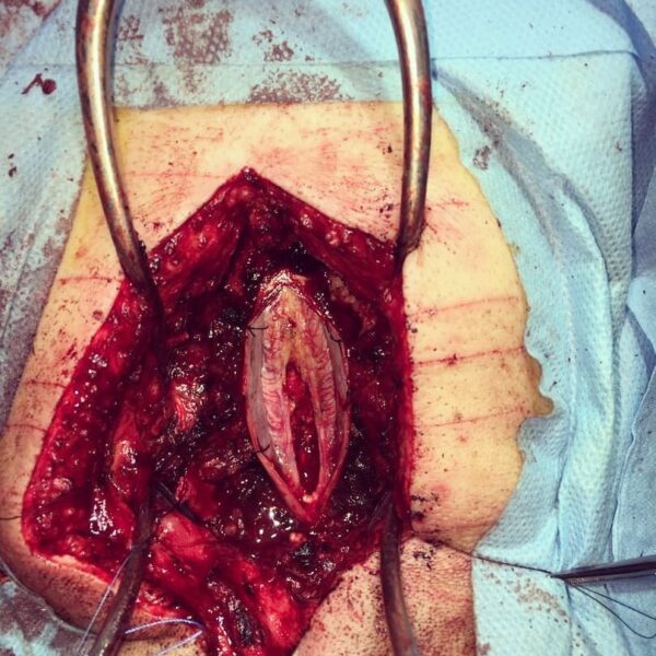 نورومانیتورینگ عمل جراحی